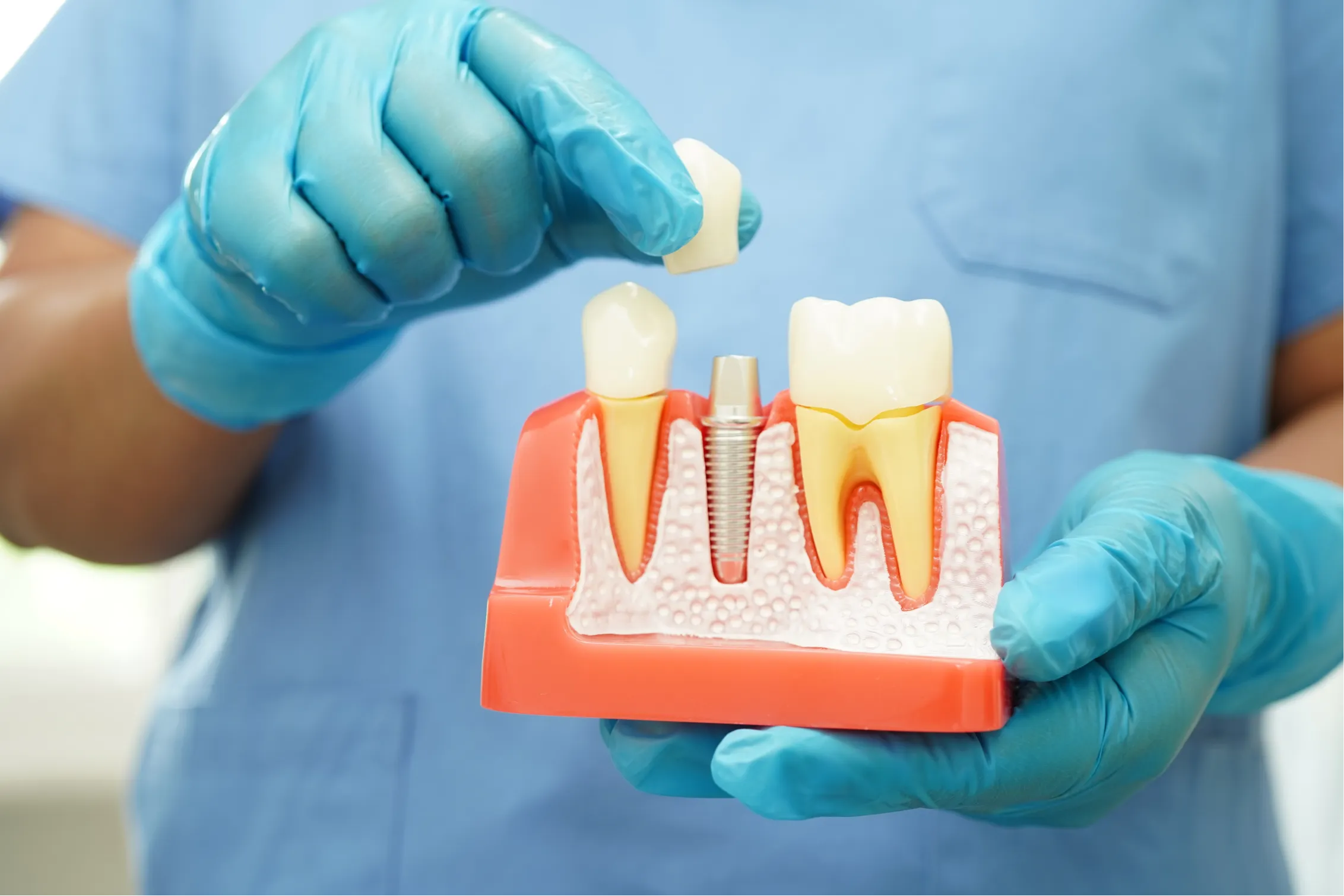 Dental implant surgery